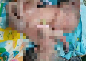 Kondisi bayi kembar siam. [Foto: Wahyu Jati]